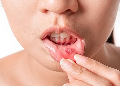 口内炎 イメージ